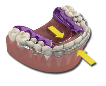 Teeth alignment