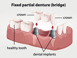 Crowns and Bridges