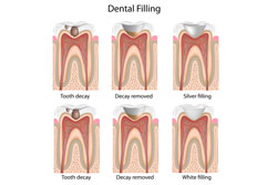 Fillings Fillings