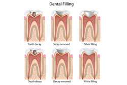 Fillings