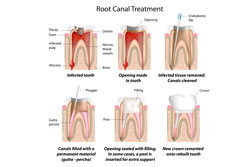 Endodontics